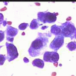 Αδενικά κύτταρα με αρραιοχρωματικούς ανισομεγέθεις πυρήνες, επίχρισμα του 2003